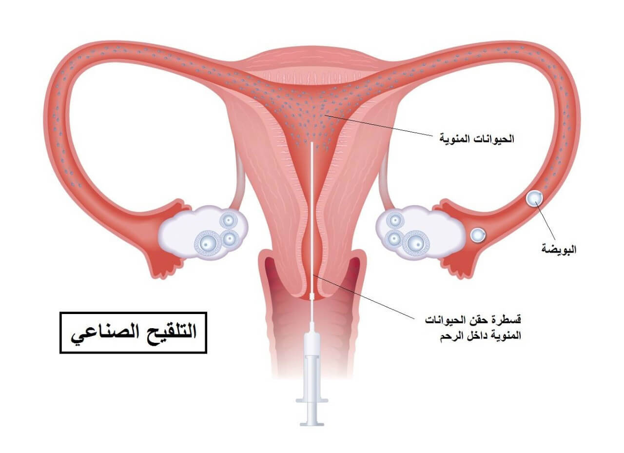 التلقيح الصناعي (IUI)